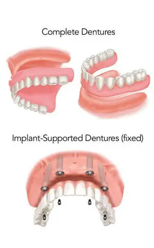 complete dentures